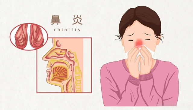 鼻炎老火？試試這個(gè)“鼻炎天下第一針”！