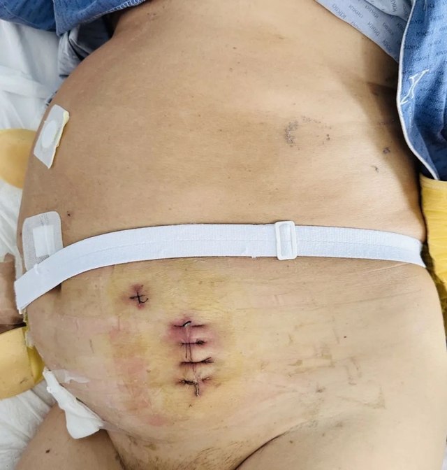 男子腸道被“堵死”，切除肛門？