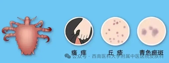 陰虱！反復清洗，撓出紅疹
