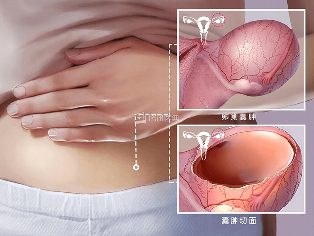 【科普】卵巢囊腫=癌癥？別慌！婦產(chǎn)科醫(yī)生為您揭秘真相！