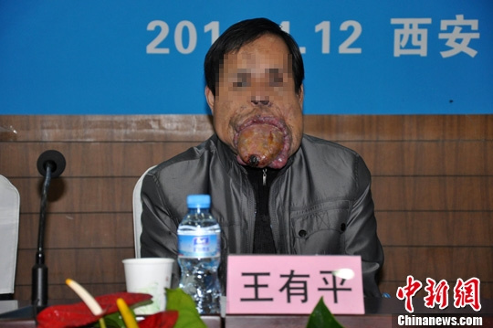 西安收治世界罕見