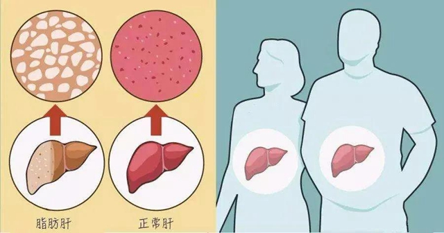 【關注】00后高中生也得脂肪肝？(圖7)
