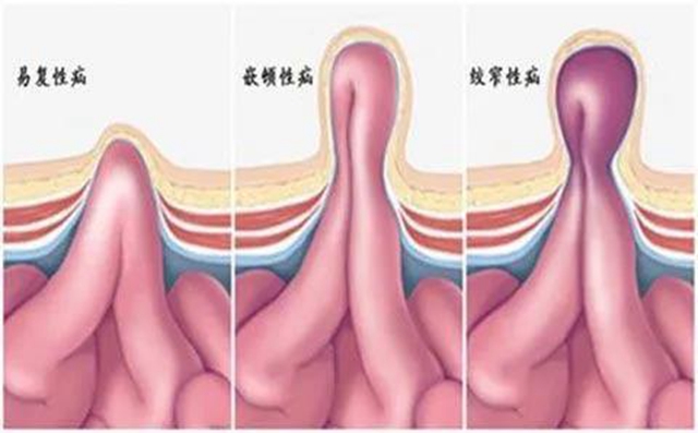 【厲害】指甲蓋大小手術(shù)切口治療疝氣！(圖8)