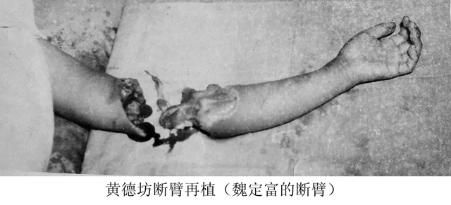 53年前，央廣向全世界播發(fā)：瀘州醫(yī)專附院為14歲少年成功接上斷臂！(圖4)