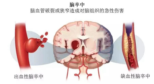 【擴散】針眼大的口子，就能檢查腦血管病？(圖2)