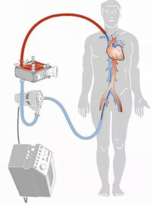 首例！救命的硬核武器—ECMO技術(shù)在西南醫(yī)大附院成功開展(圖1)