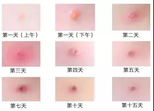 川南學生家長速看：當前已進入水痘高發(fā)期！(圖3)