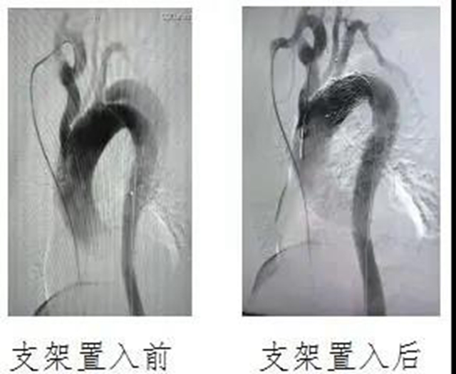 瀘州市人民醫(yī)院首次獨(dú)立成功完成復(fù)雜胸腹主動脈夾層血管腔內(nèi)修復(fù)術(shù)(圖4)