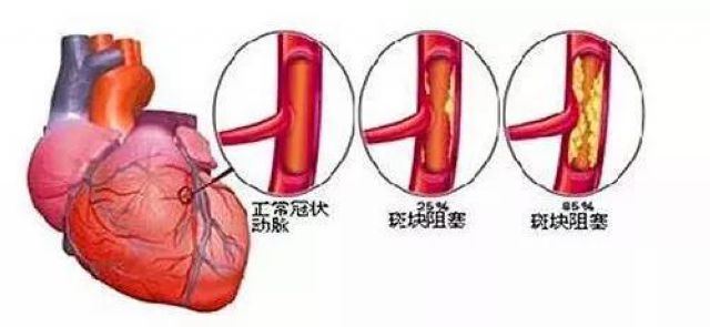 你的心臟在求救！急性心梗的這些預(yù)警信號， 你知道嗎？(圖2)