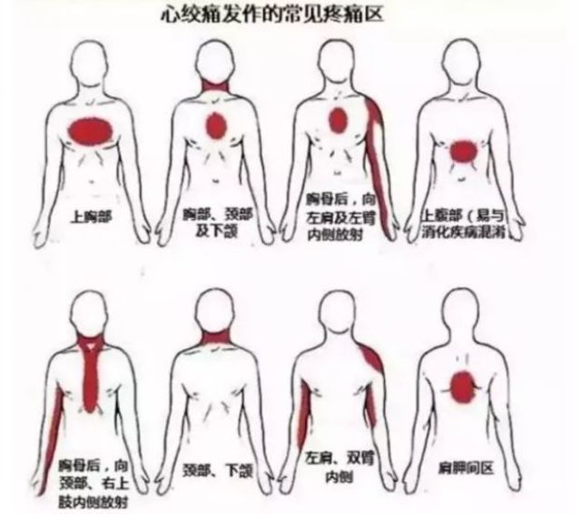 你的心臟在求救！急性心梗的這些預(yù)警信號， 你知道嗎？(圖8)