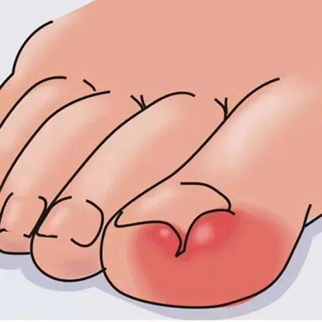 【擴(kuò)散】腳指甲剪太短！代價(jià)可不只是痛……(圖2)