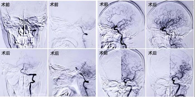 七旬婆婆突發(fā)腦梗死，深夜搶救1小時(shí)完全恢復(fù)！(圖5)