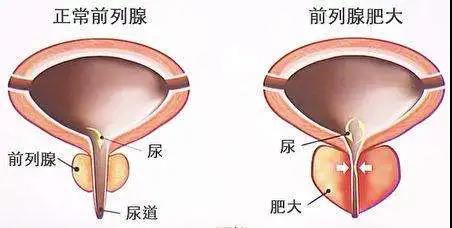 【擴散】男性專屬，一旦發(fā)現(xiàn)，大部分已是晚期？(圖2)