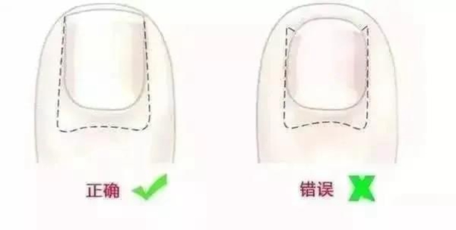 【擴(kuò)散】腳指甲剪很短，感覺很爽？！代價(jià)卻很……(圖5)