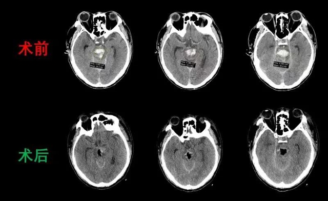 腦干出血，中年漢子命懸一線；專家聯手，分秒必爭化解危機(圖5)