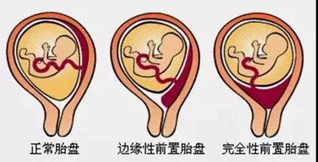 【兇險】胎盤完全堵住宮口，二胎媽媽差點送命？(圖3)