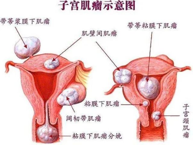 【女性】子宮肌瘤！該慌，還是不慌？(圖2)