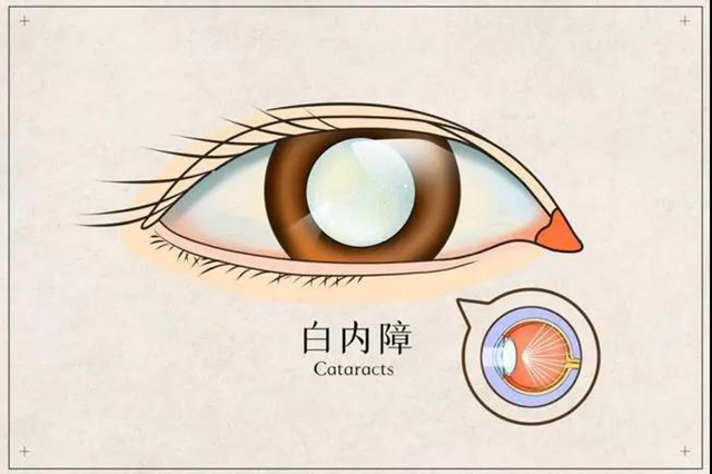 【提醒】躲不過的白內(nèi)障，究竟何時(shí)做才最有效？
