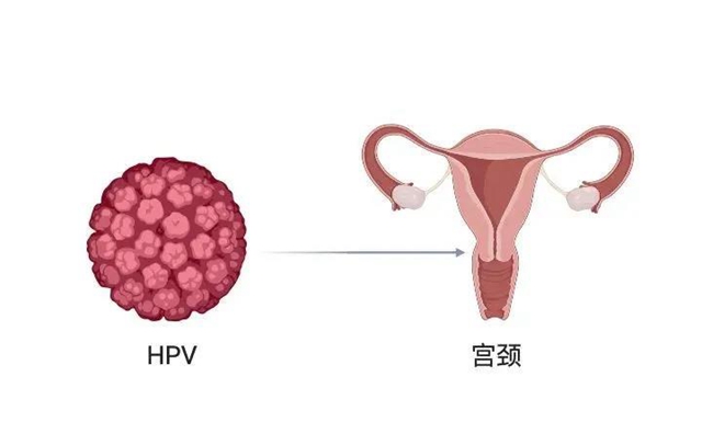 【擴散】感染了HPV病毒，就是得了宮頸癌？