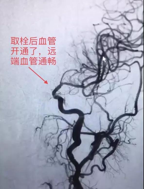 轉發(fā)可以救命！中風急救，抓住黃金4.5小時(圖4)