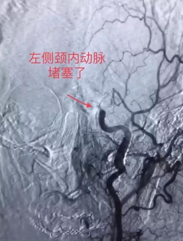 轉發(fā)可以救命！中風急救，抓住黃金4.5小時(圖3)