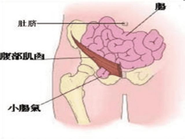 【擴散】孩子哭鬧后大腿根鼓個包？居然是……(圖3)