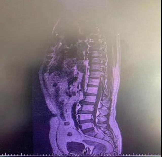 【關(guān)注】男子腰痛，醫(yī)生取出21顆“骨頭渣渣”！(圖3)