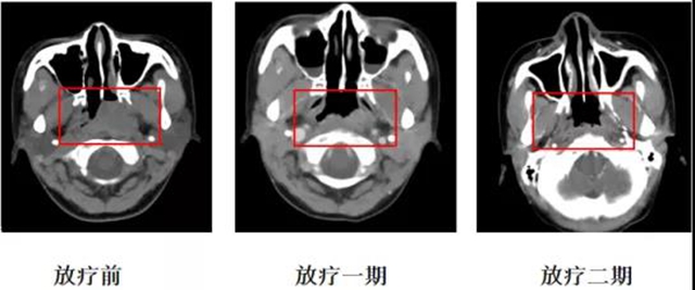 所有的腫瘤患者都需要放療嗎？(圖6)
