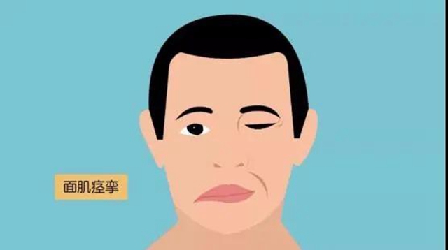 【關(guān)注】左眼跳財(cái)，右眼跳災(zāi)？可能是面痙攣！(圖4)