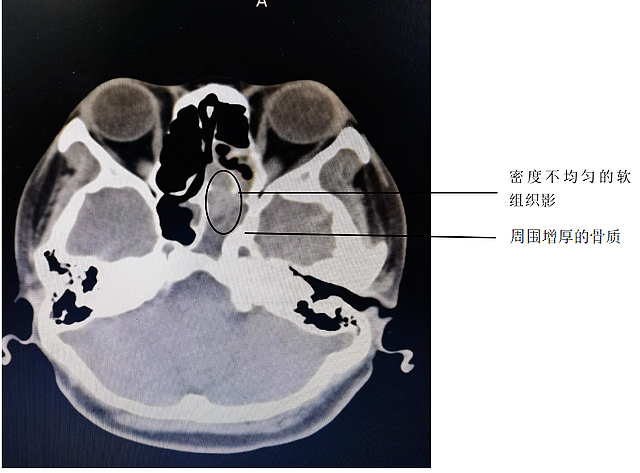 【圍觀】咳到出血，原來是鼻子出問題了